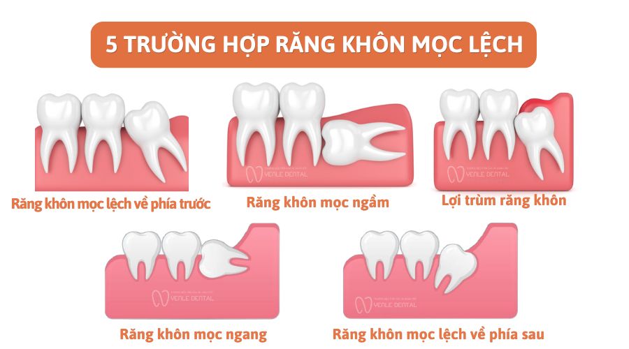 răng khôn mọc lệch
